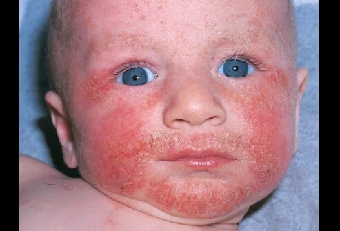 Alergi kulit dermatitis atopik.