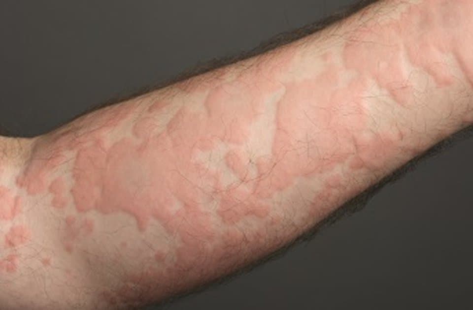 Alergi kulit biduran
