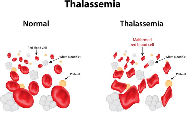 thalasemia