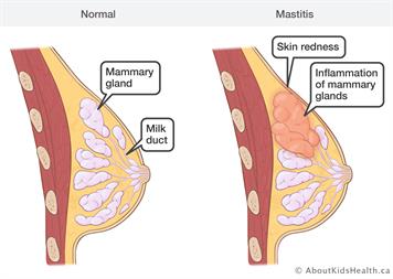 ciri-ciri mastitis payudara